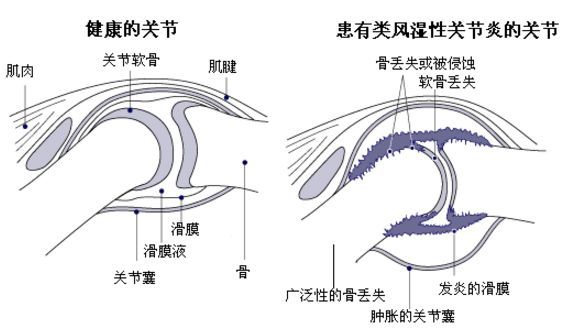 科普|类风湿性关节炎的诊断标准有哪些？